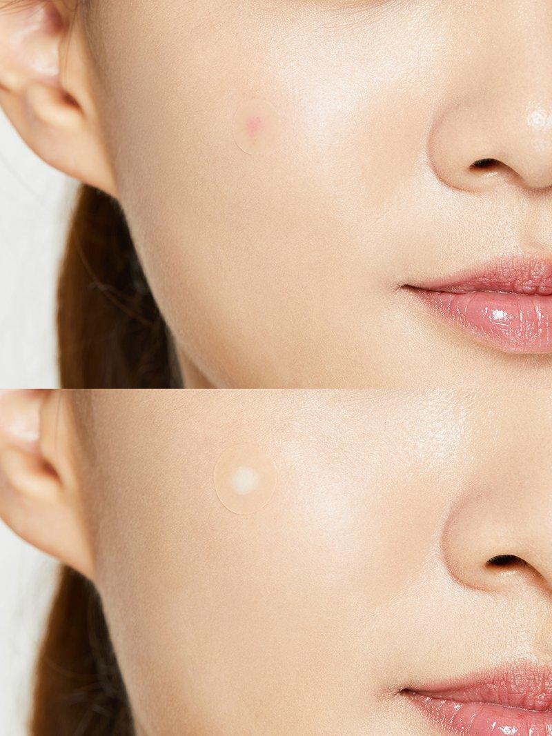 Acne Pimple Master Patch 24 buc.